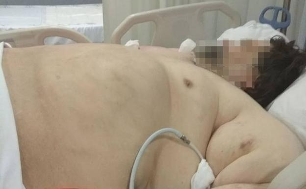 La obesidad extrema que padece Juan José le impide moverse. /SUR